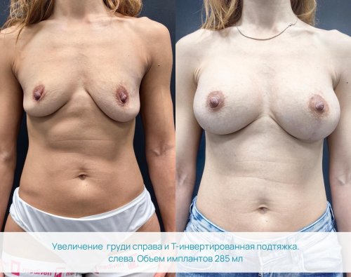 Грудь пластика