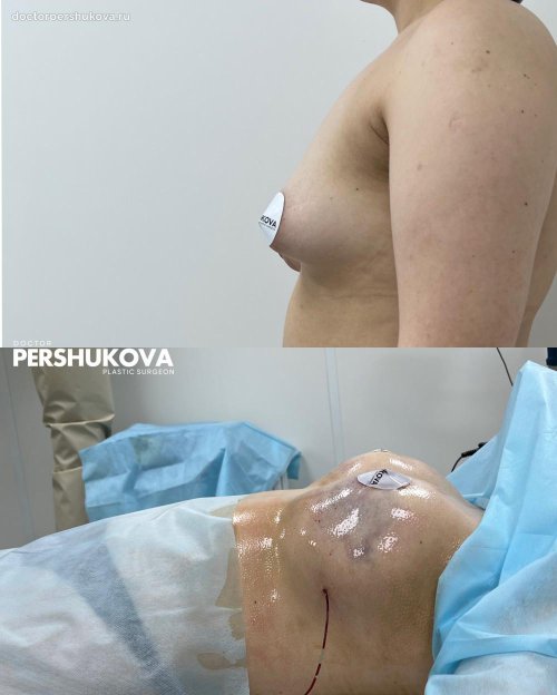 Увеличение груди имплантами