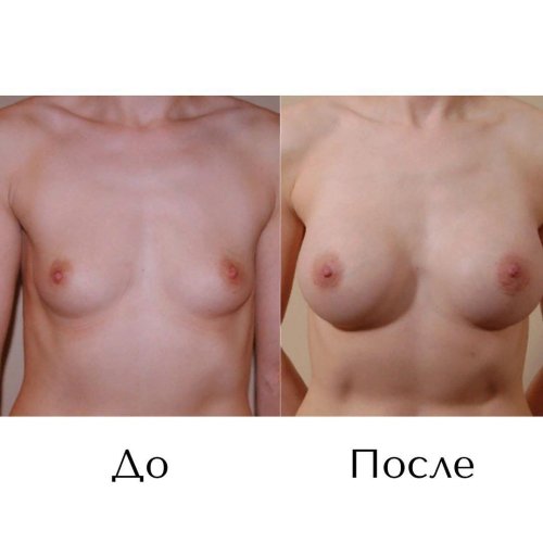 До и после увеличения груди