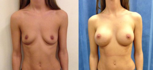 Breast reduction dr richard