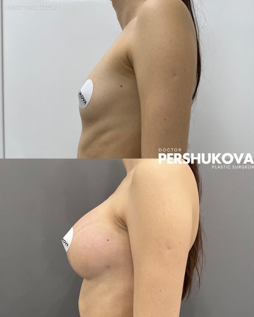 Увеличение груди анатомическими имплантами
