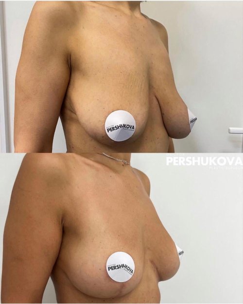 До и после подтяжки груди