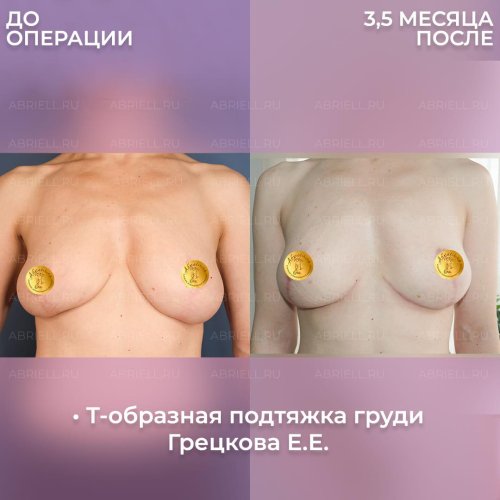 Т образная подтяжка груди