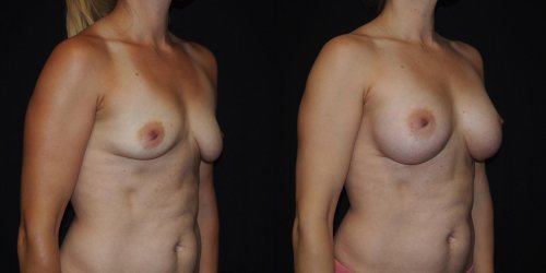 Breast reduction dr richard