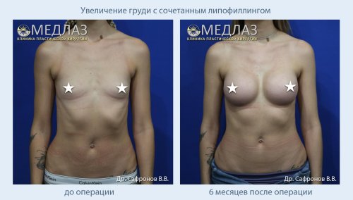 Увеличение груди