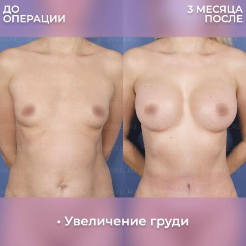 Увеличение груди