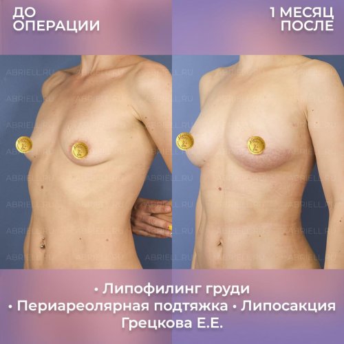 Липофилинг груди