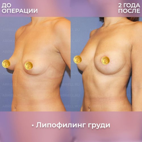 Липофилинг груди
