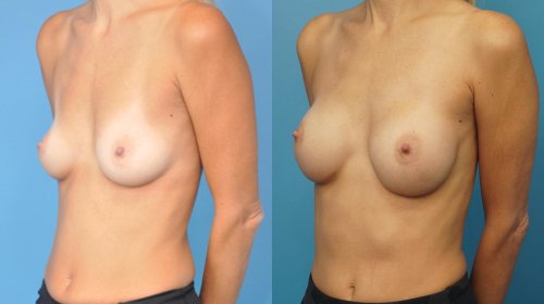 Breast reduction dr richard