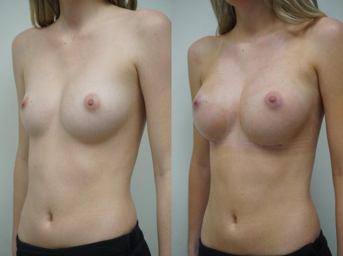 Breast augmentation
