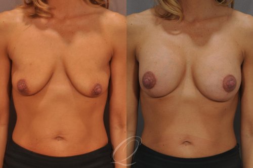 Breast reduction dr richard